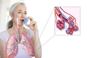 Бронхиальная астма - один из клинических вариантов аллергии. Не путать с атопической бронхиальной астмой, которая возникает по другим причинам.
