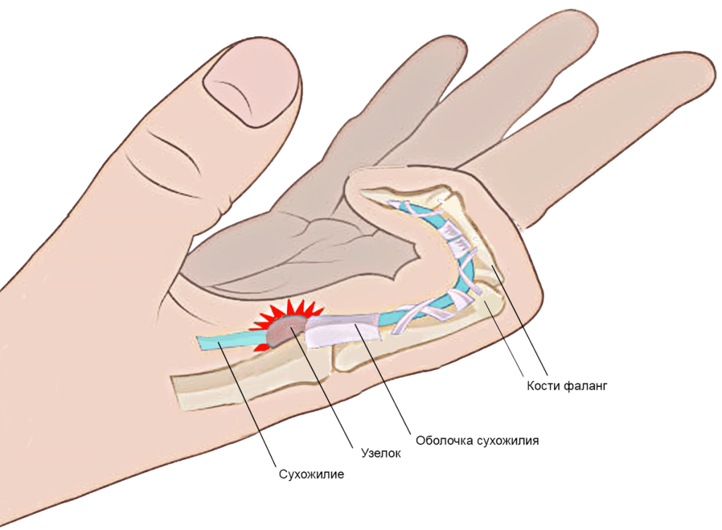 Причина щелкающего пальца - утолщение кольцевидной связки, мешающей двигаться сухожилию