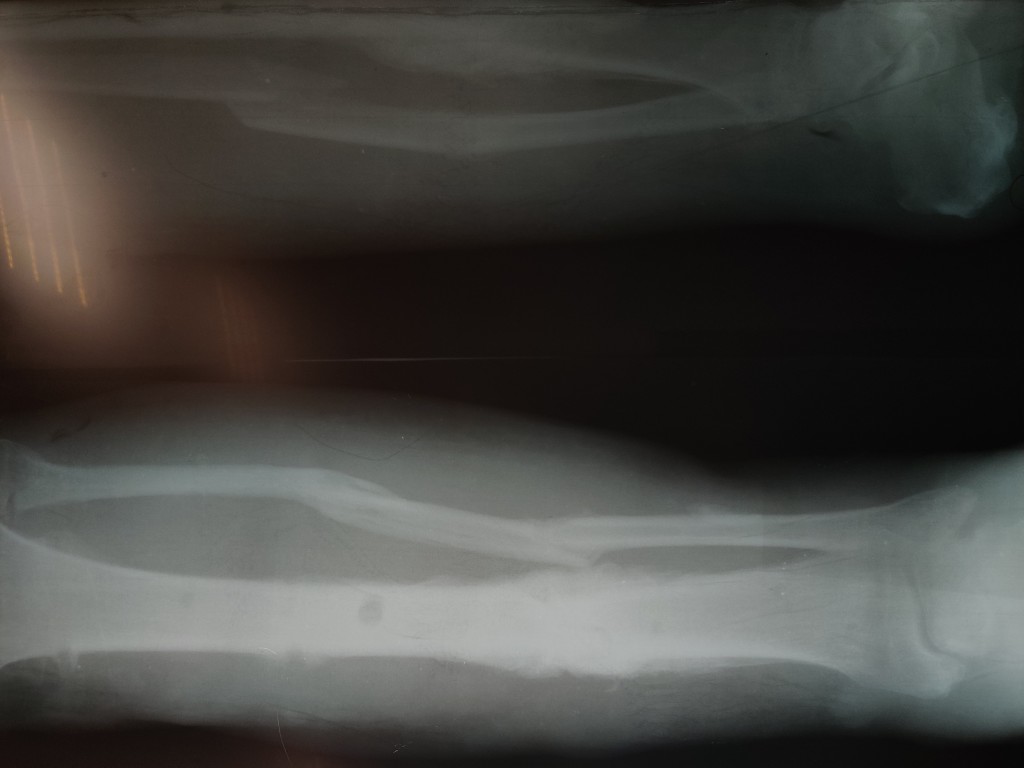Рентгенограммы после демонтажа аппарата Илизарова