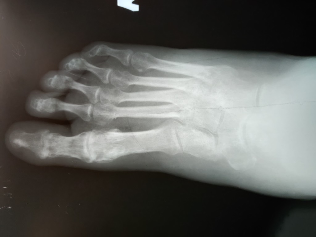 Рентгенограммы после демонтажа аппарата Илизарова