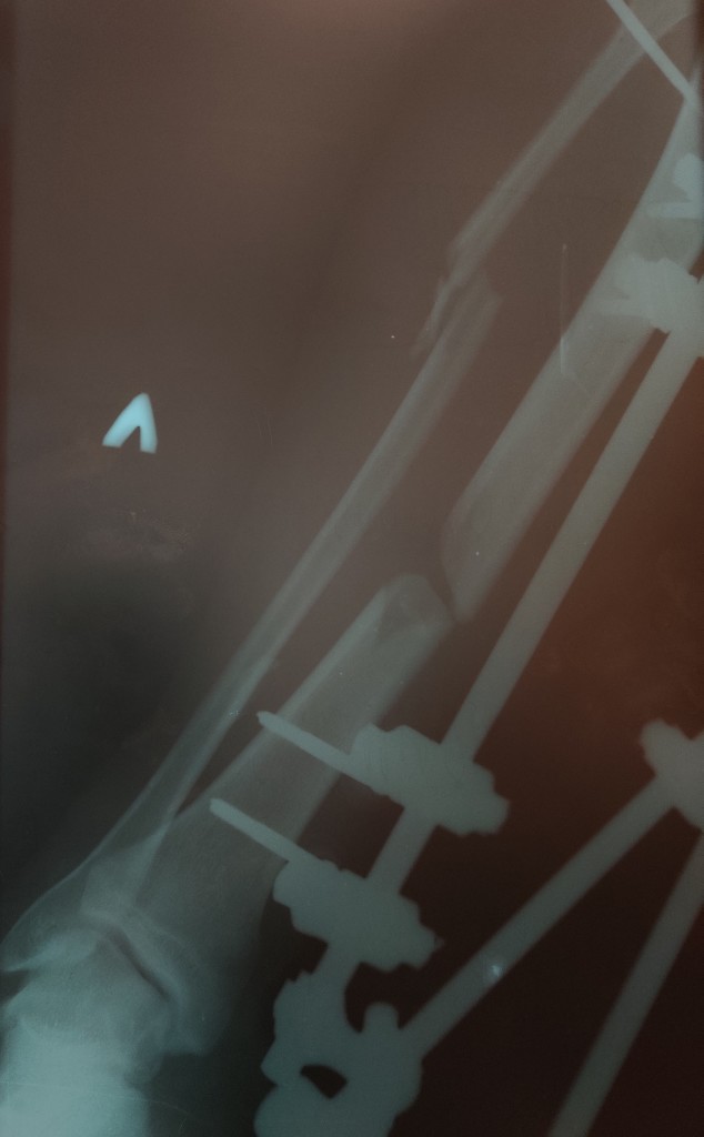 Рентгенограмма после фиксации левой голени стержневым аппаратом наружной фиксации