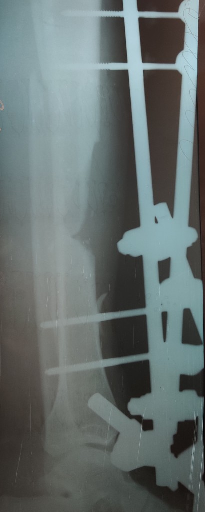 Рентгенограмма после фиксации стержневым аппаратом наружной фиксации