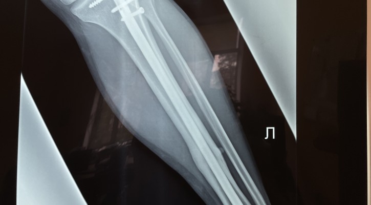 Рентгенограммы перед удалением - определяется сросшийся перелом голени