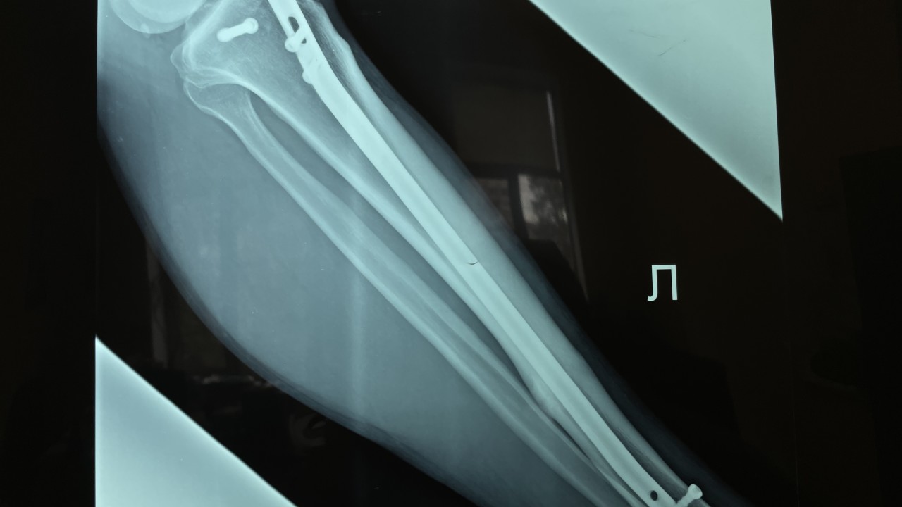 Рентгенограммы перед удалением - определяется сросшийся перелом голени