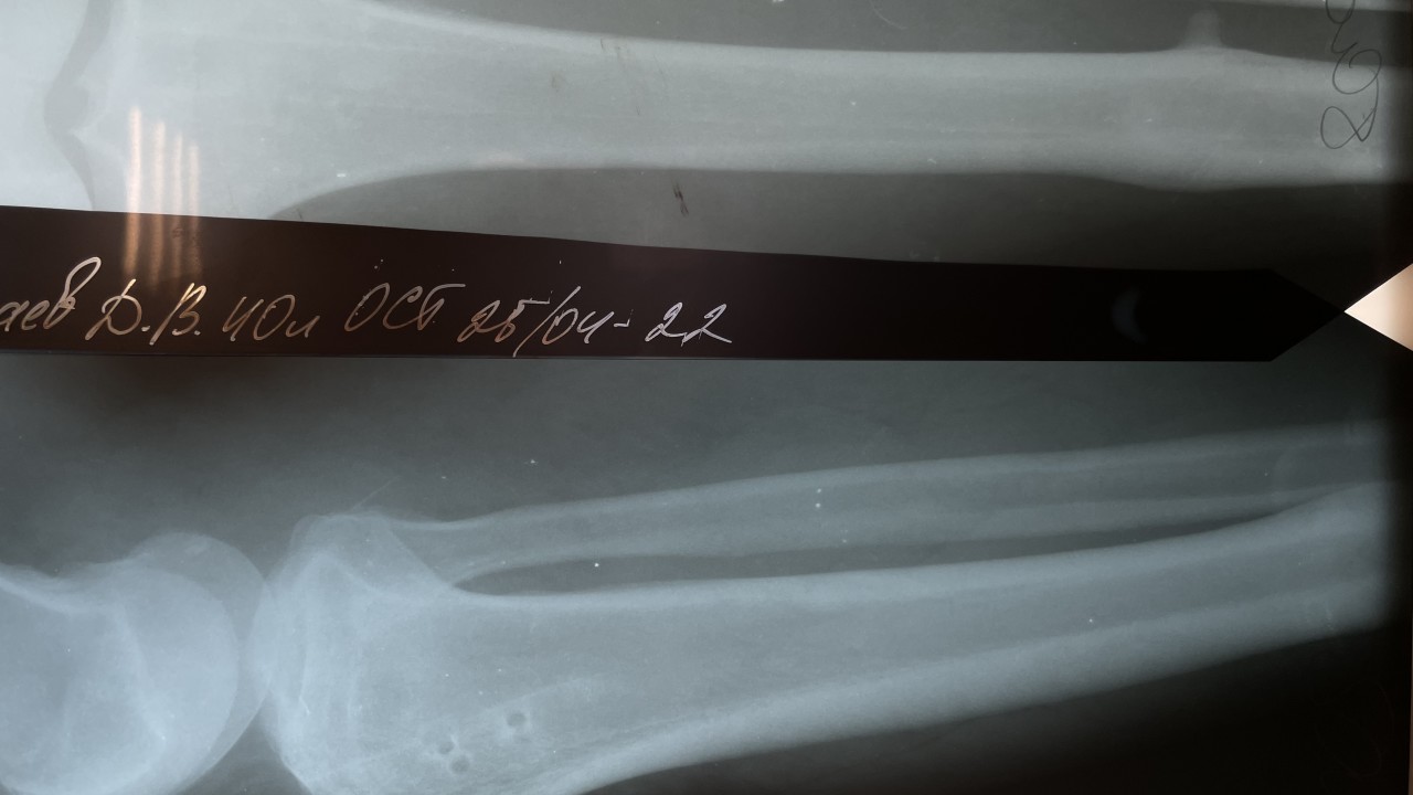 Рентгенограмма после удаления металлофиксаторов