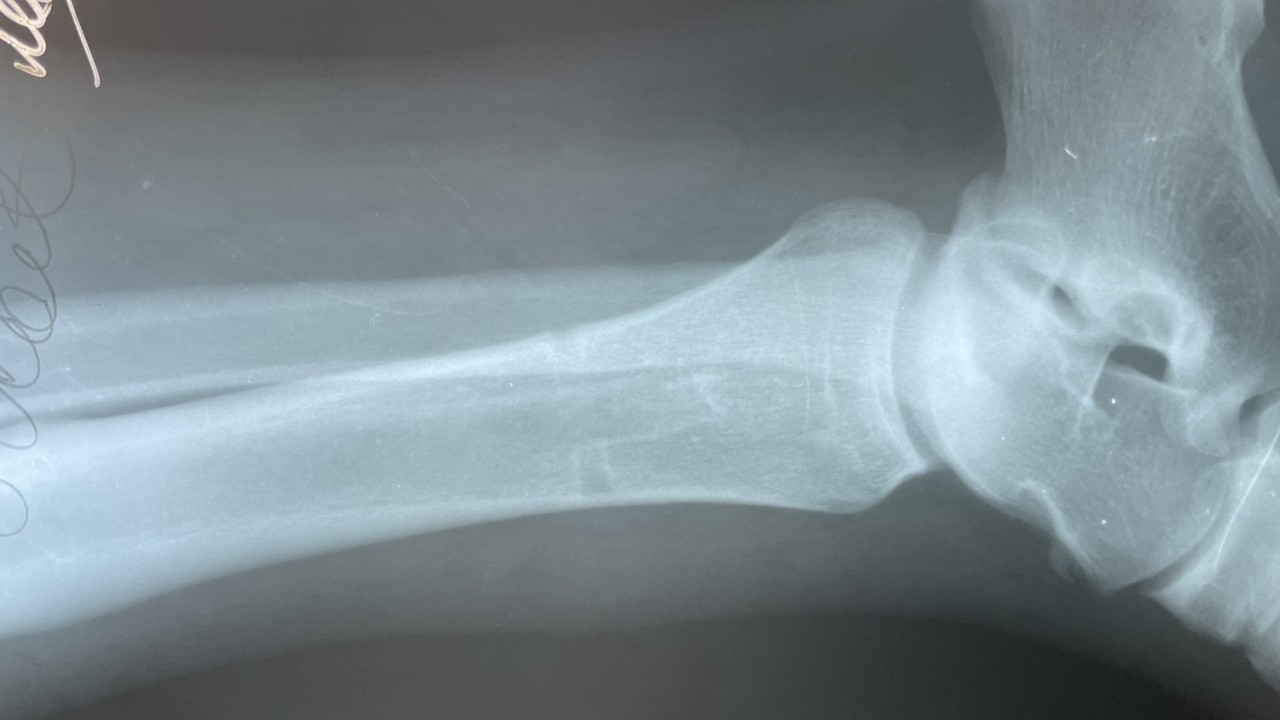 Рентгенограмма после удаления металлофиксаторов