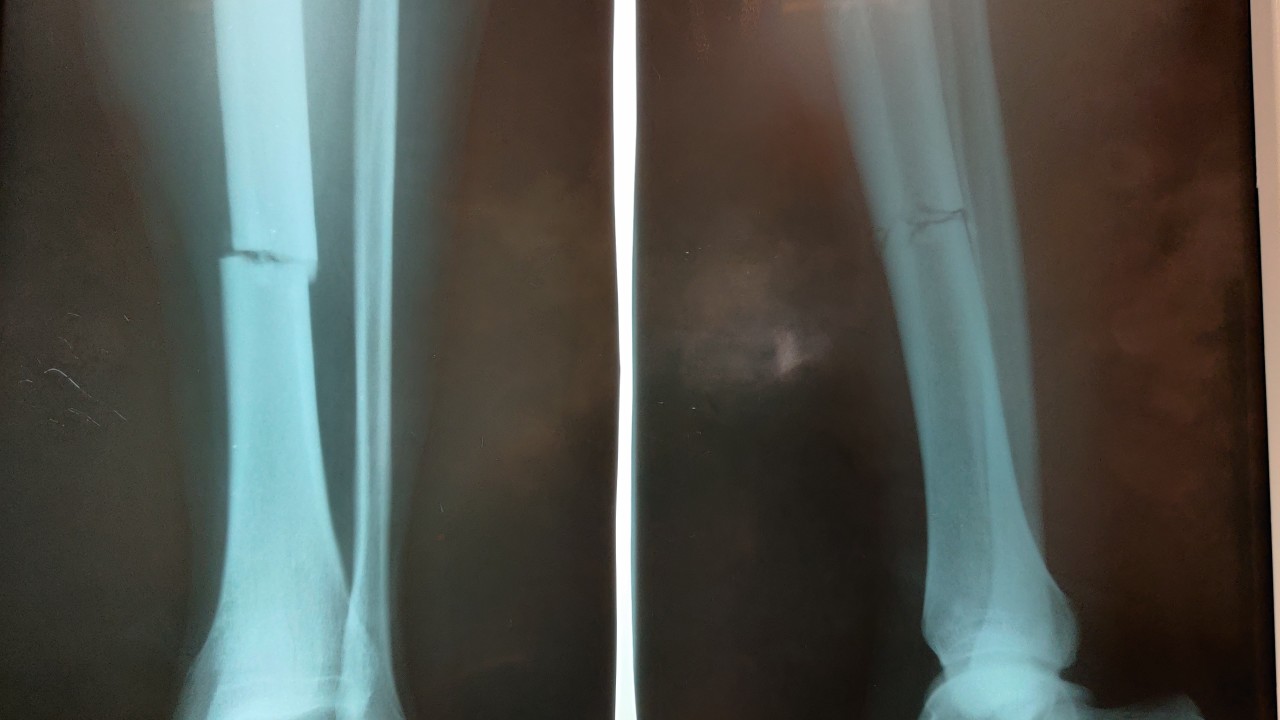 Первичные рентгенограммы после травмы. Определяется перелом левой большеберцовой кости в средней трети