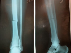 Первичные рентгенограммы после травмы. Определяется перелом левой большеберцовой кости в средней трети