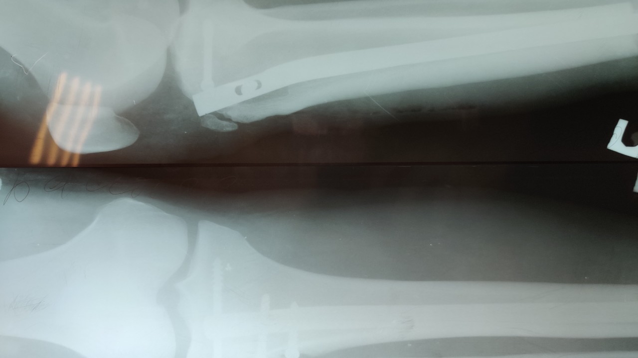 Рентгенограмма после операции - перелома зафиксирован интрамедуллярным штифтом